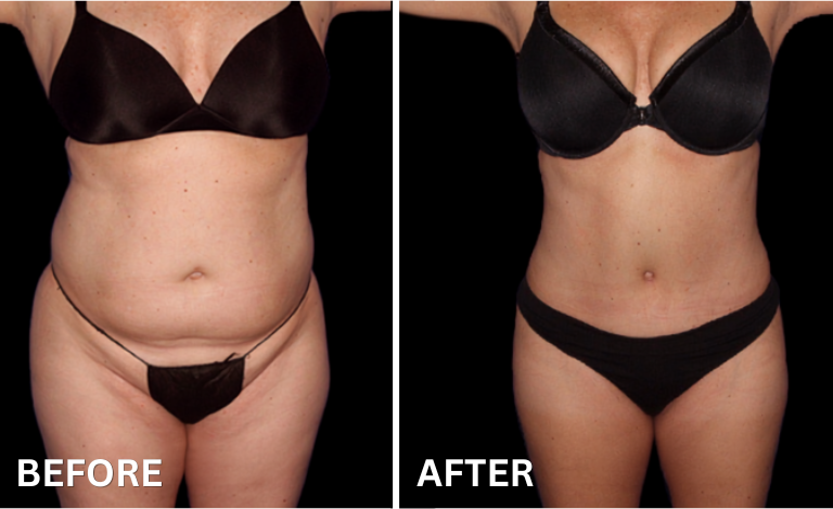 Before and after — Tummy Rescue transformation, SageWood Institute client