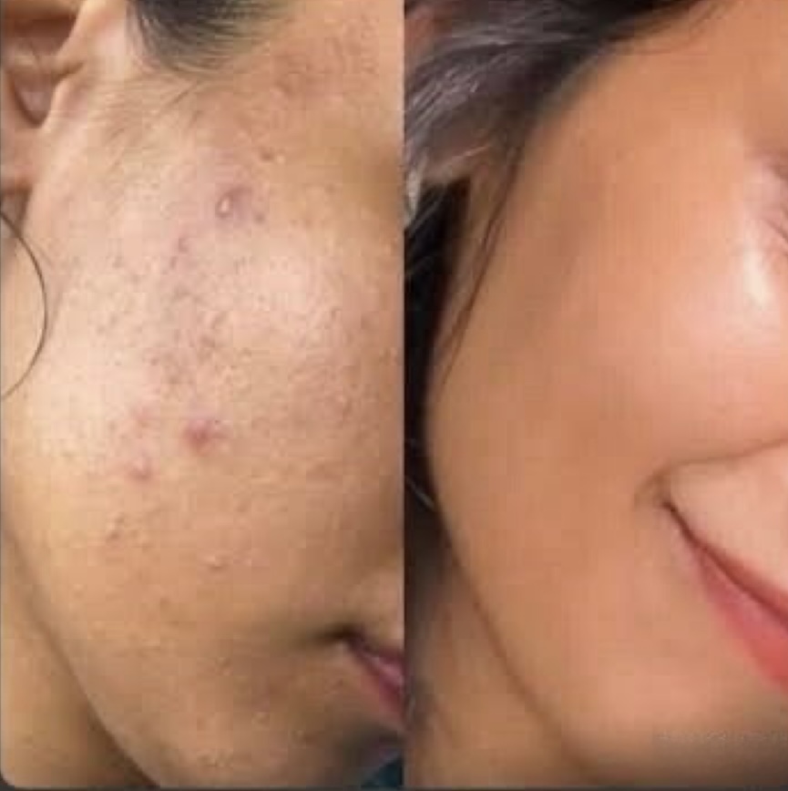 Clear Skin, No Filters