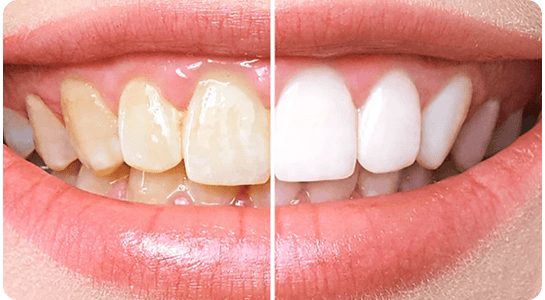 Teeth Whitening