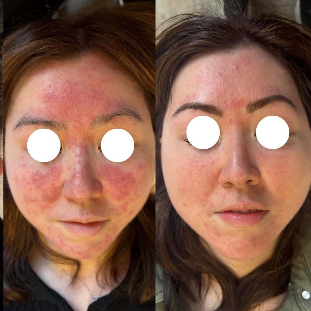 rosacea