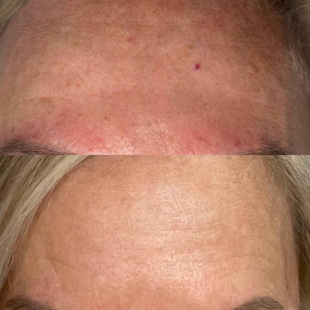 rosacea