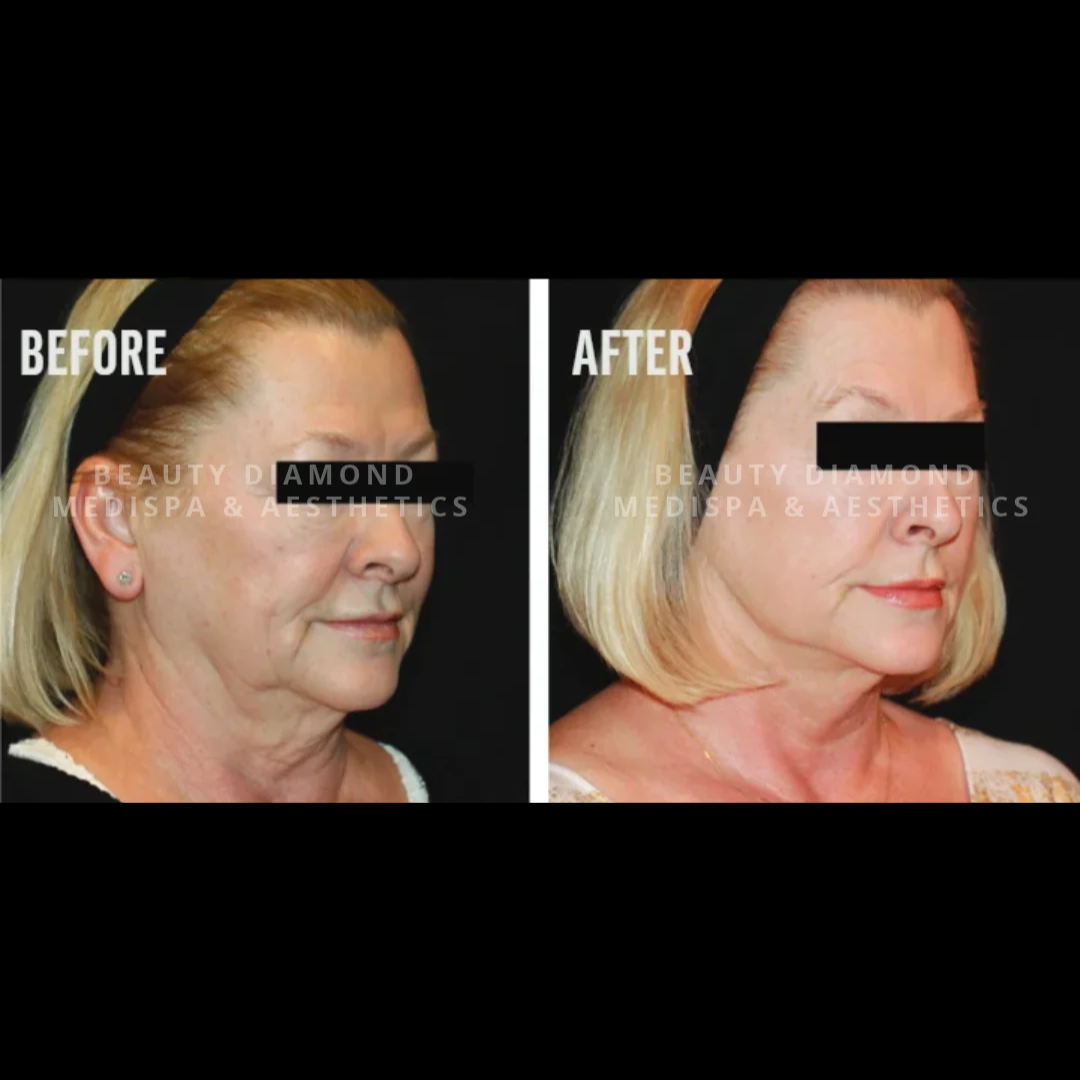 Profound Matrix Pro before and after results