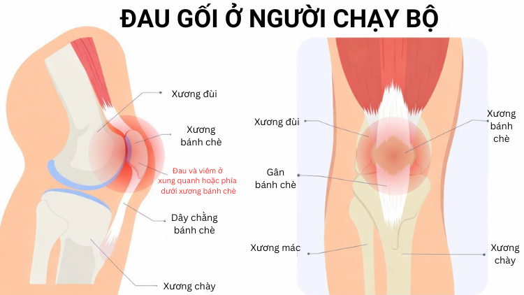 đau đầu gối ở người chạy bộ đau đầu gối ở người chạy bộ