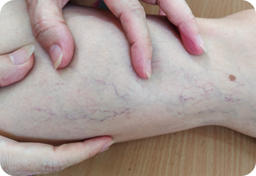 Venous insufficiency