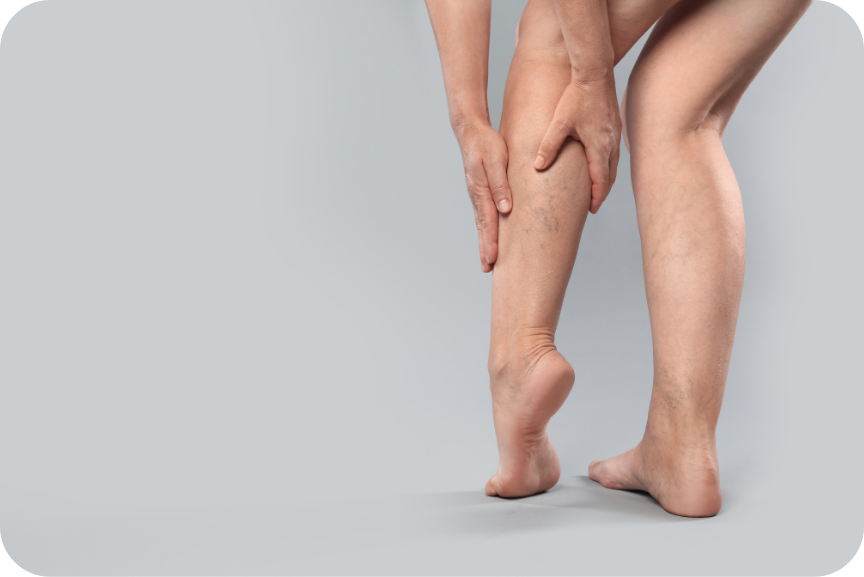 Venous Insufficiency