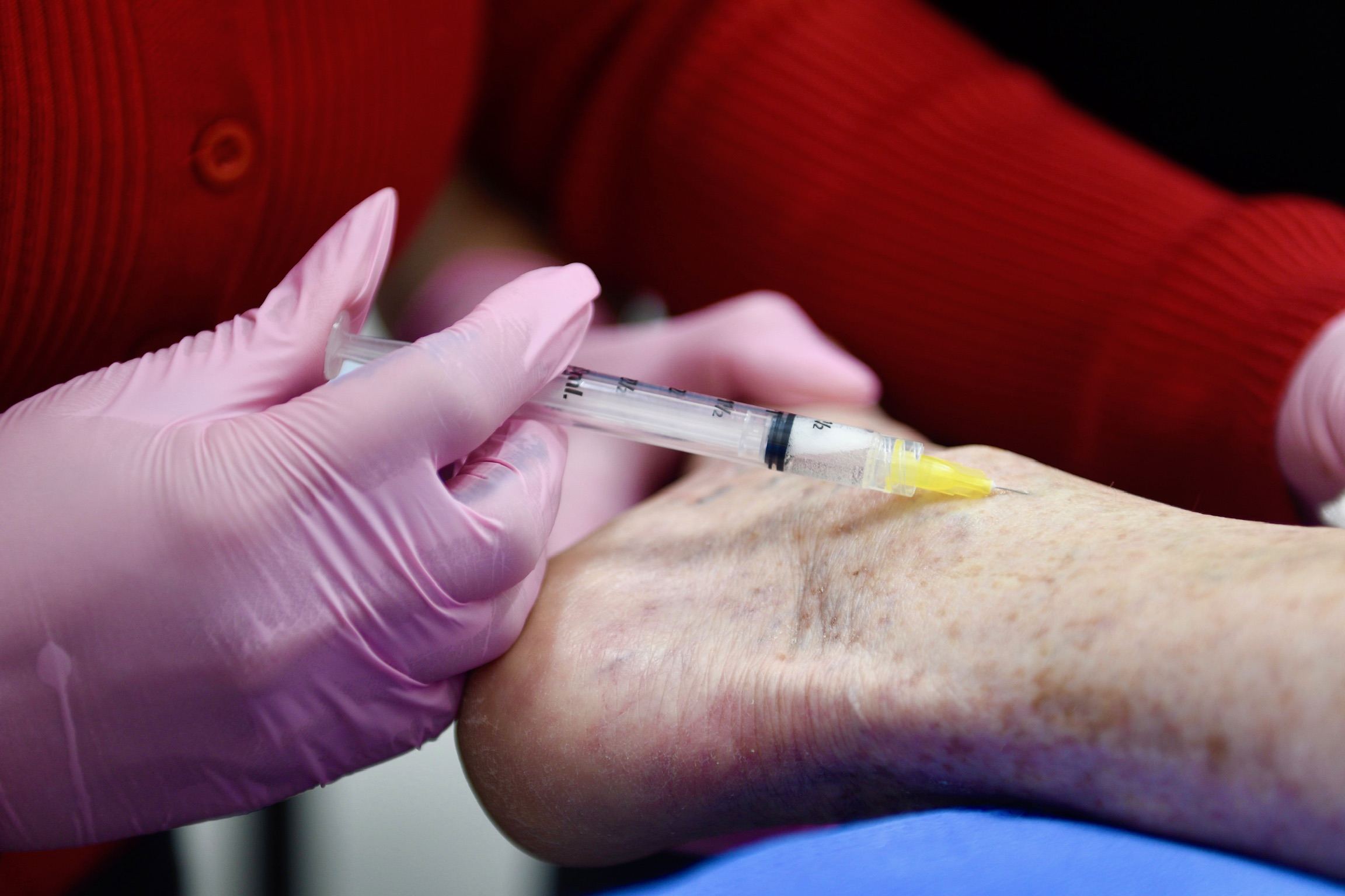Sclerotherapy injection treating spider veins at Smooth Skin Vein and Laser in Clear Lake, TX