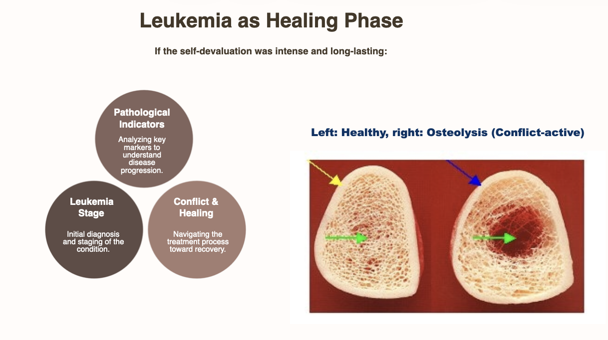 Leukemia Leukemia