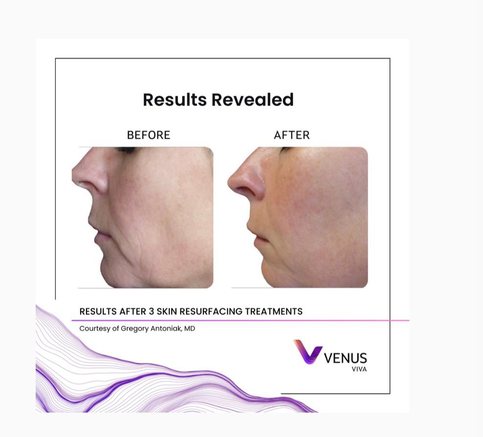 Venus Viva skin result