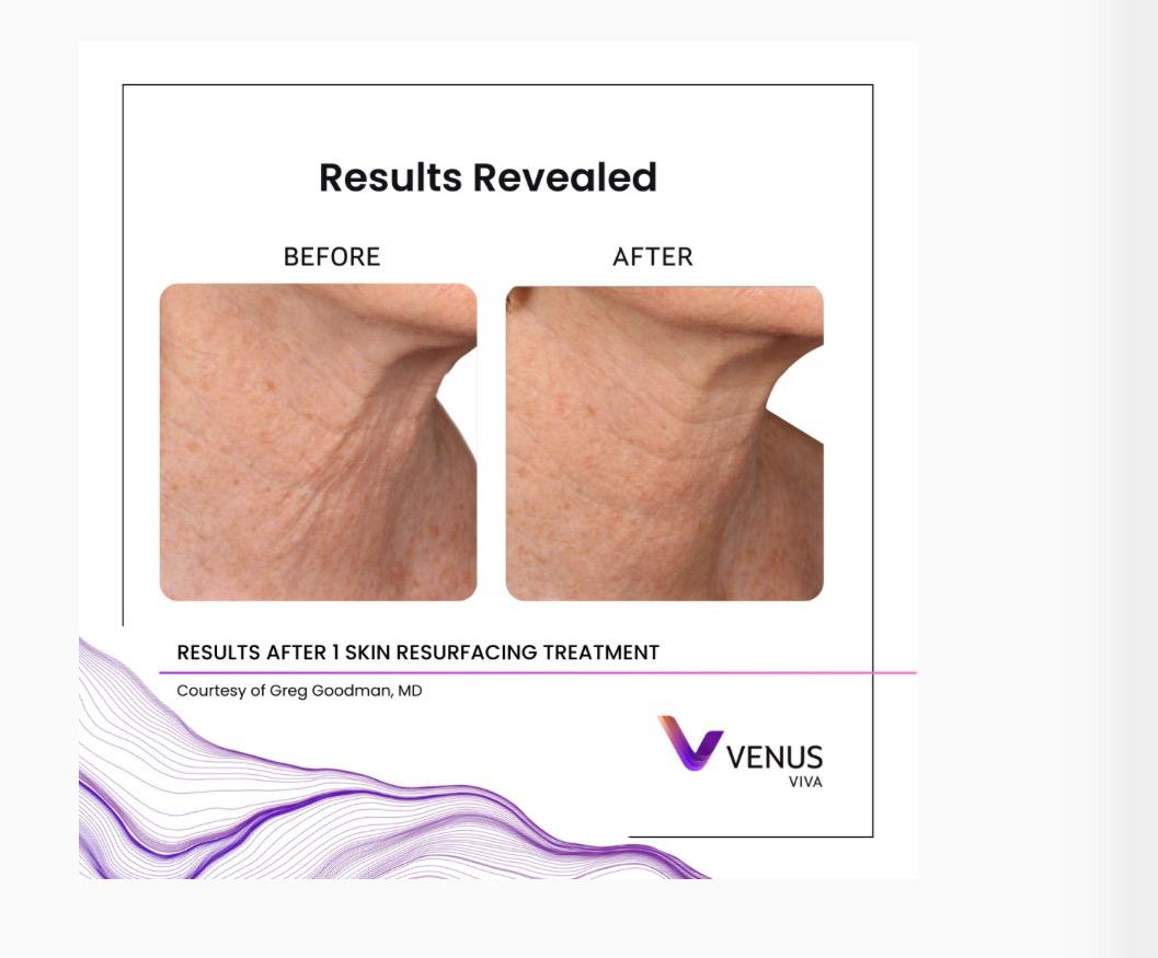 Venus Viva skin result