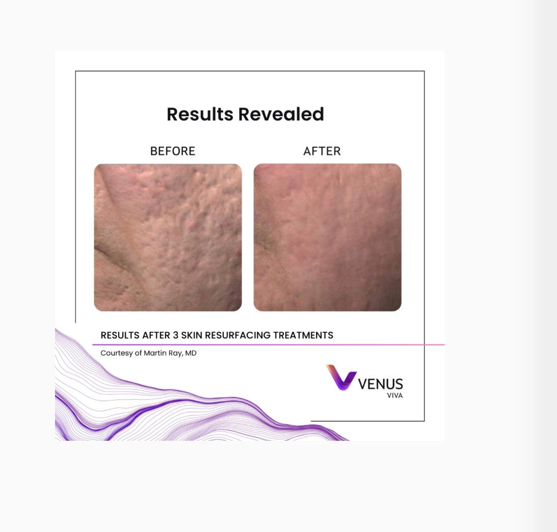 Venus Viva skin result