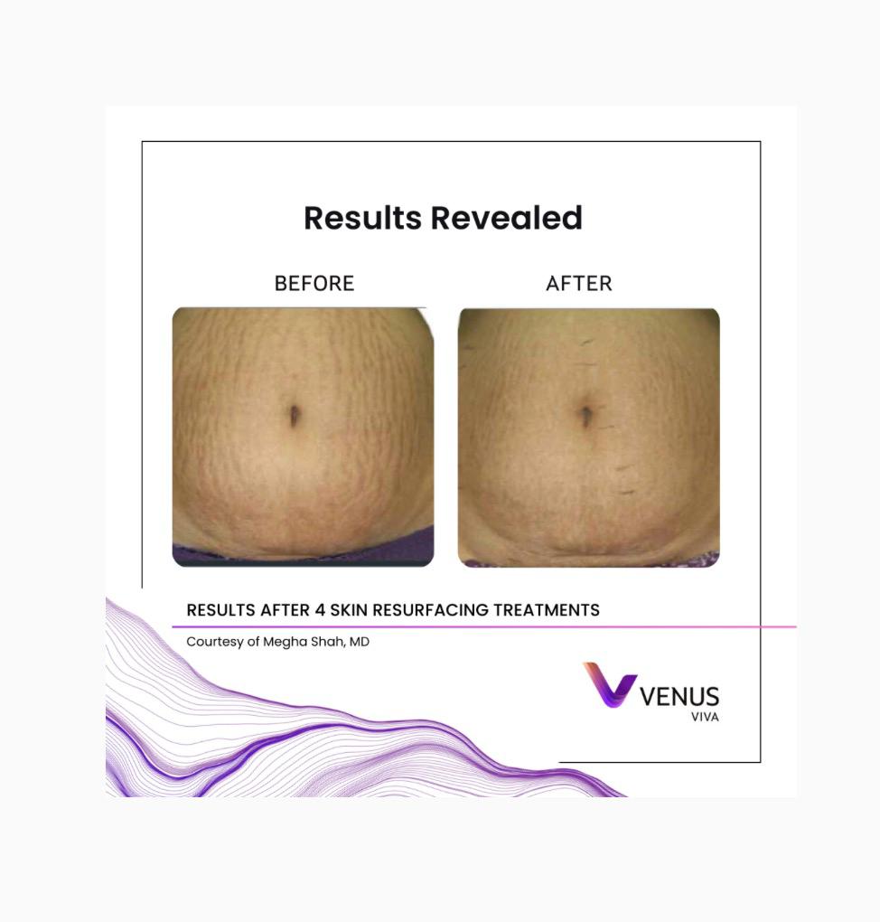 Venus Viva skin result