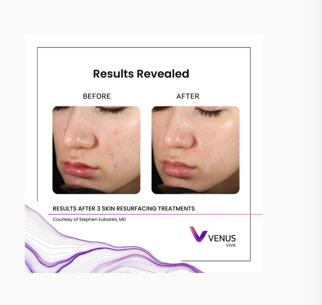 Venus Viva skin result