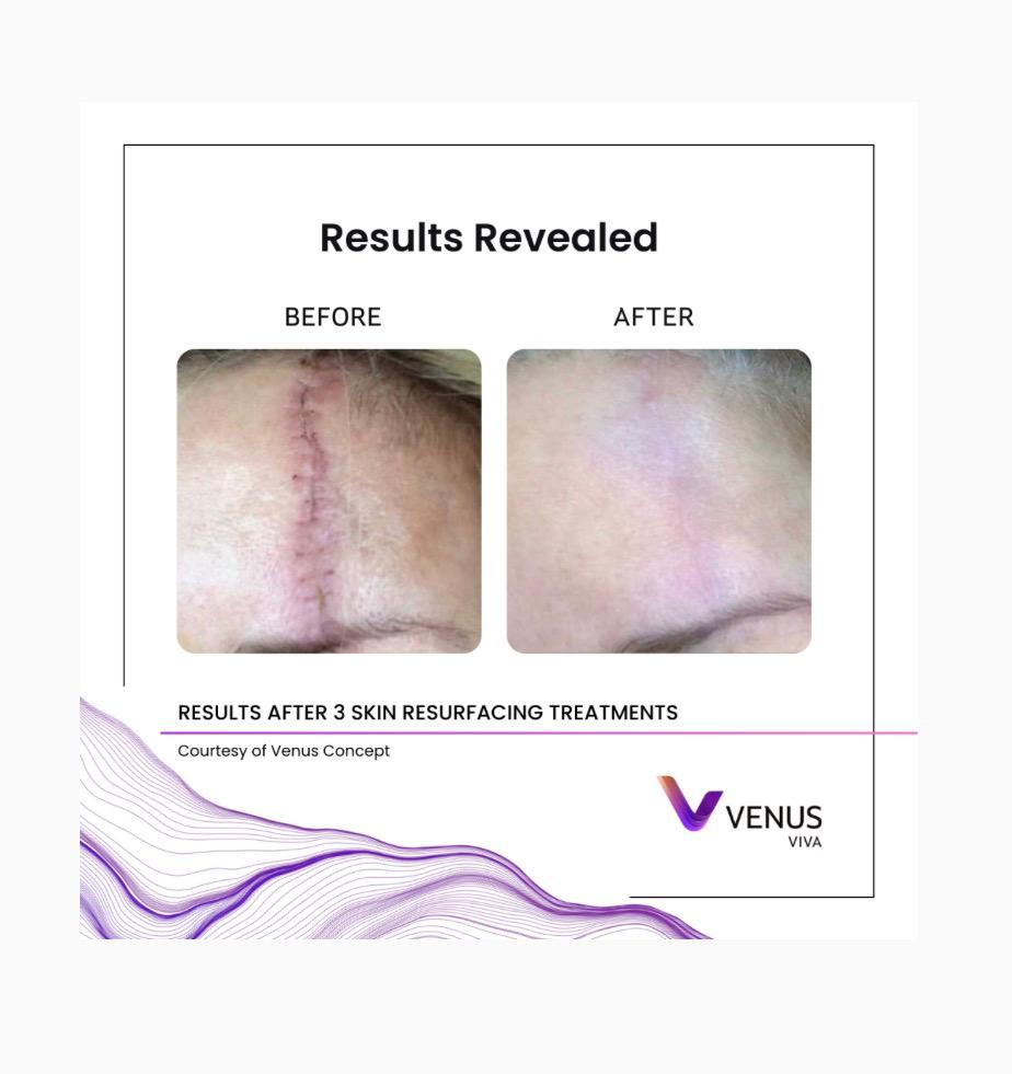 Venus Viva skin result