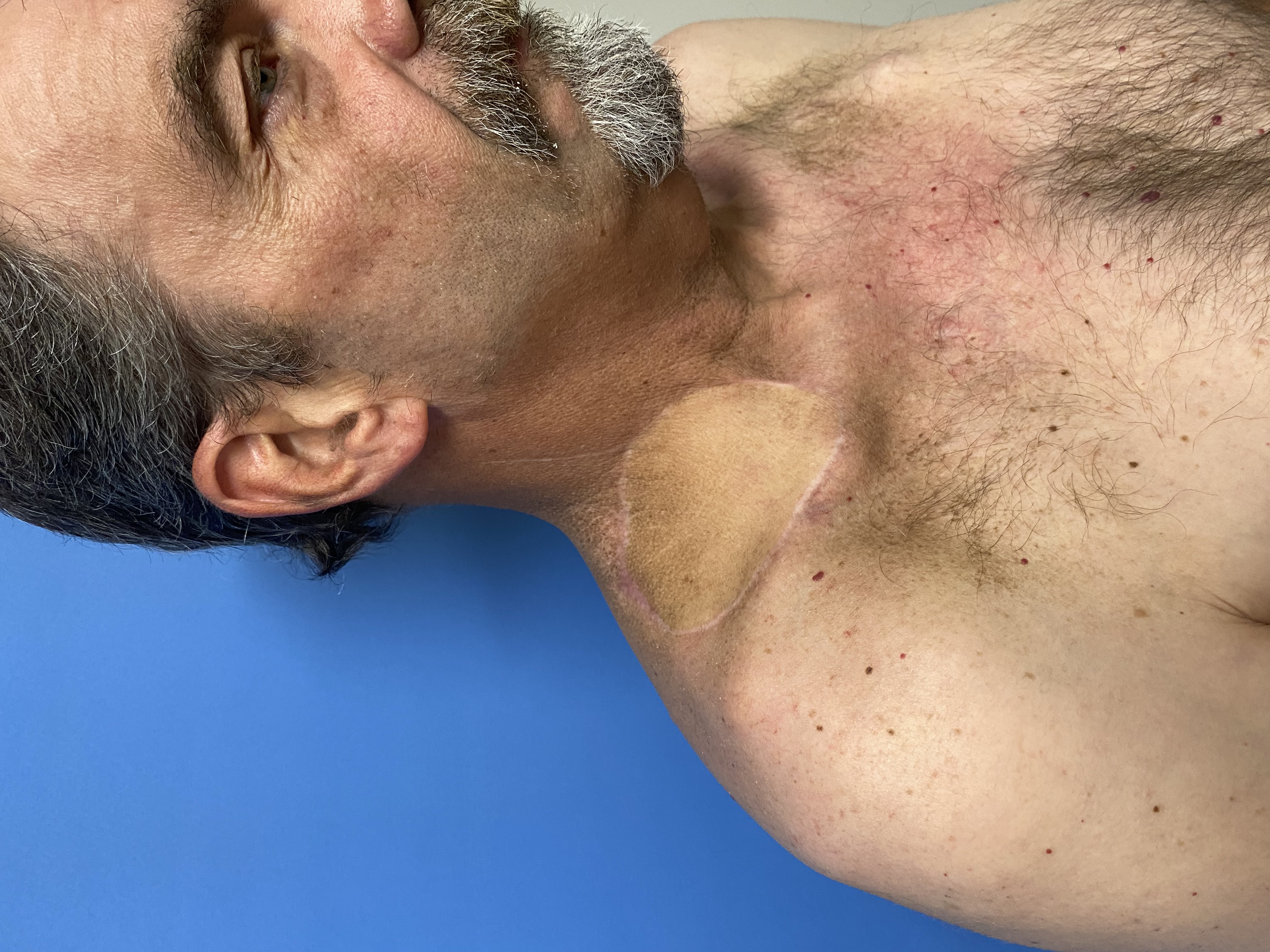 Post-operative clinical photograph — Post-Op — Angle 1 for Facial Reconstruction & Lesion Resection