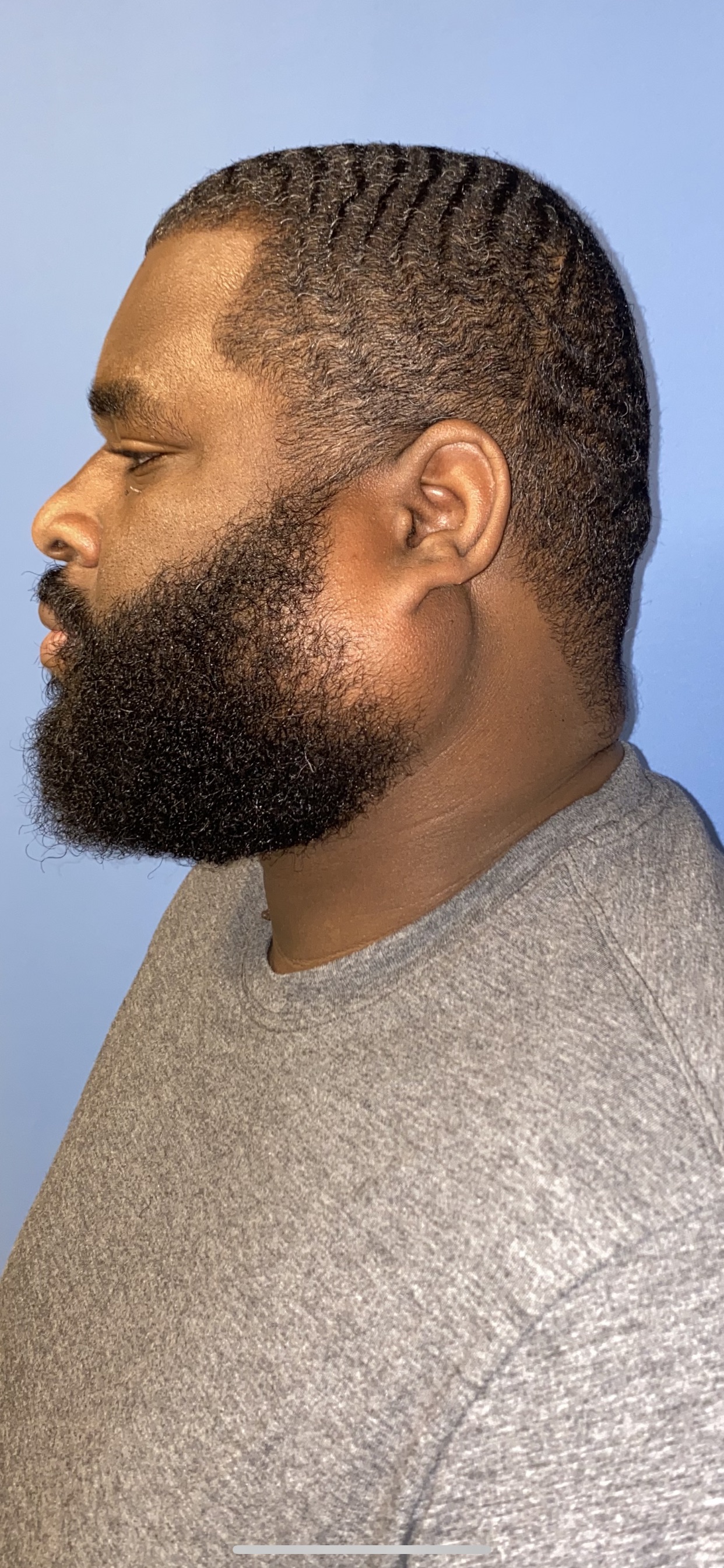 Pre-operative clinical photograph — Pre-Op — Angle 2 (Lateral) for Facial Tumor Resection & Reconstructive Surgery