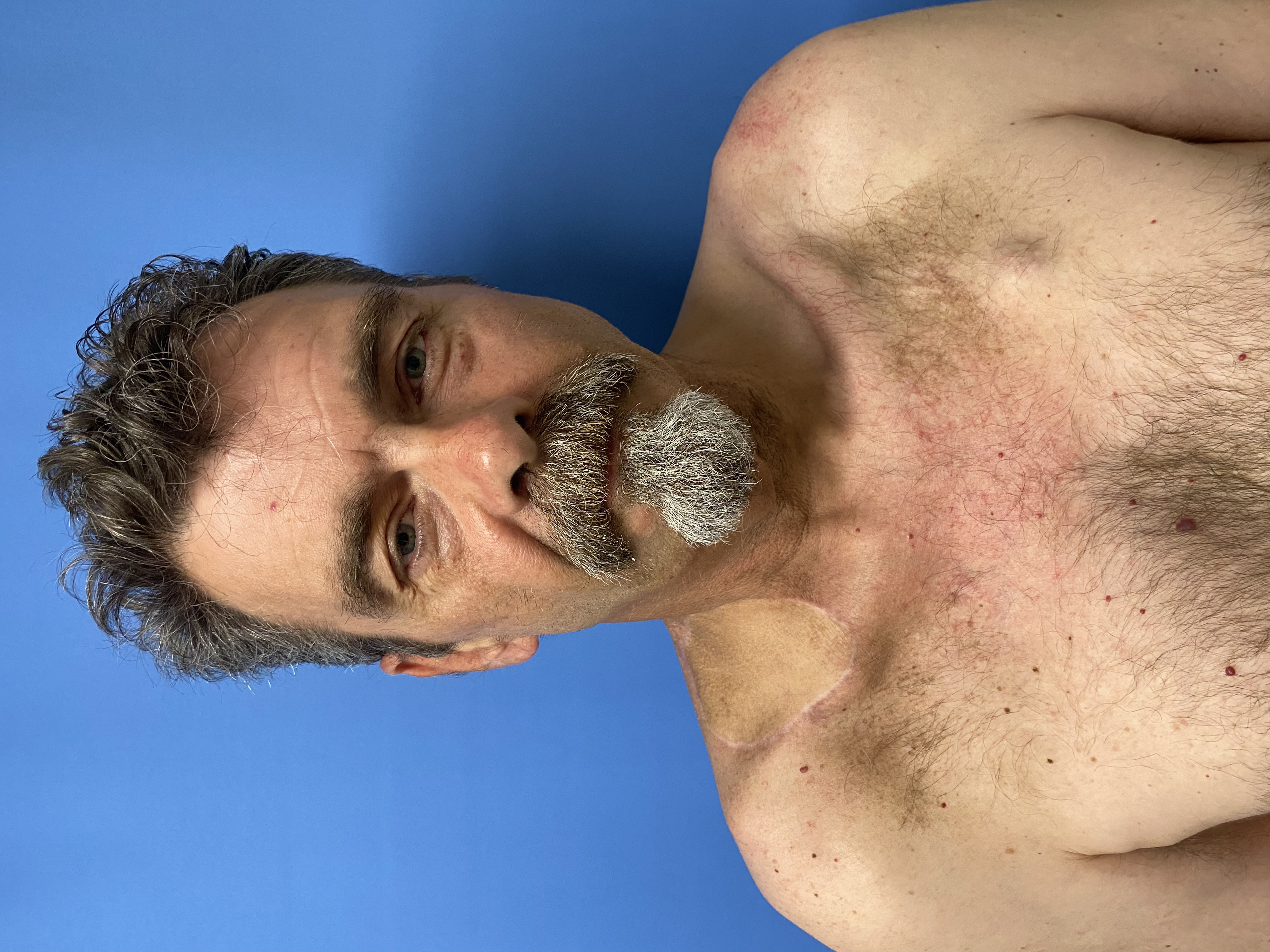 Post-operative clinical photograph — Post-Op — Angle 2 for Facial Reconstruction & Lesion Resection