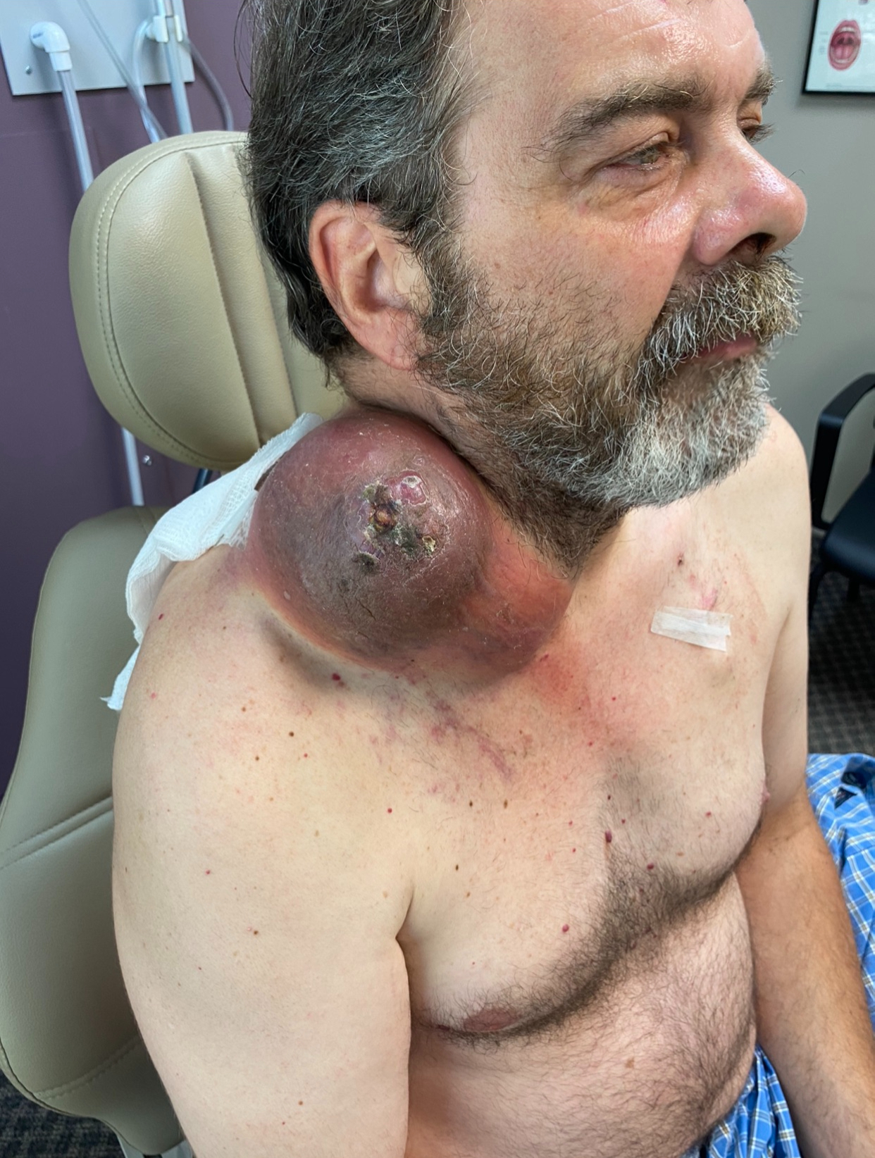 Pre-operative clinical photograph — Pre-Op — Angle 1 for Facial Reconstruction & Lesion Resection