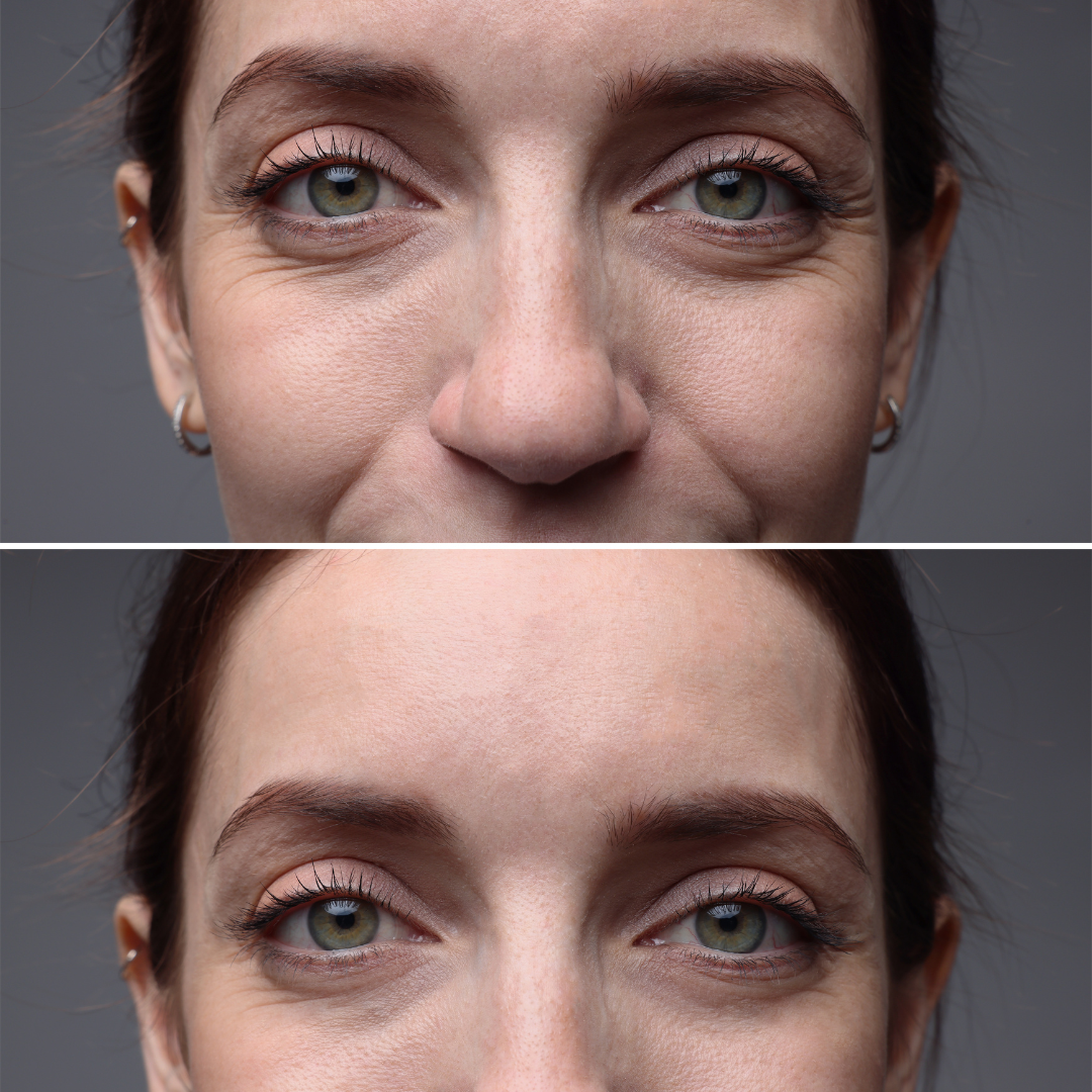 triLift Procedure