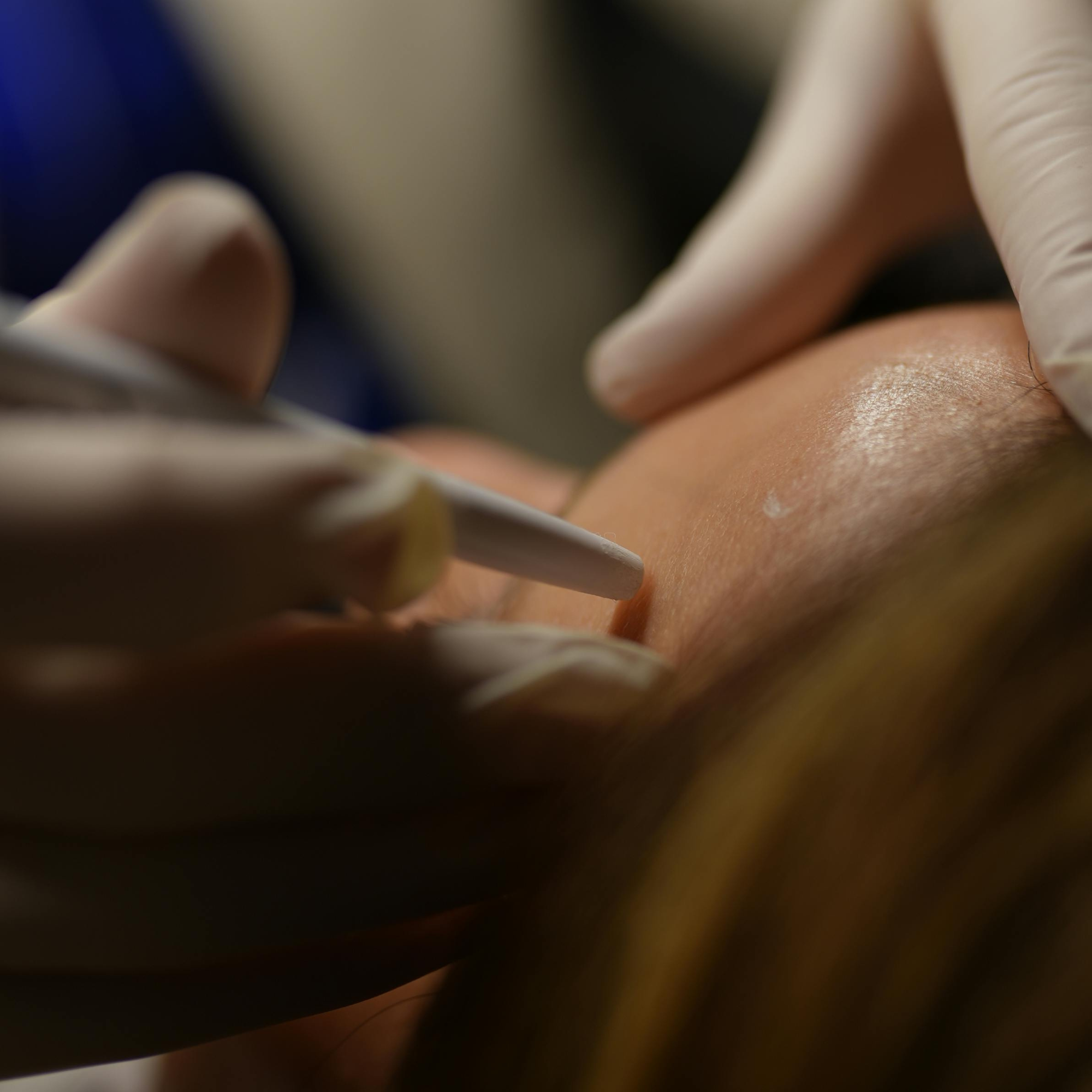 Microneedling