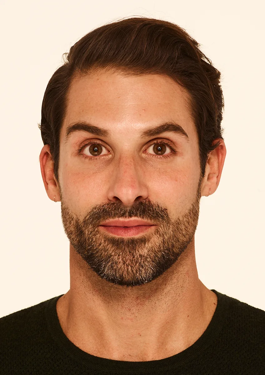 Neuromodulator After - Forehead