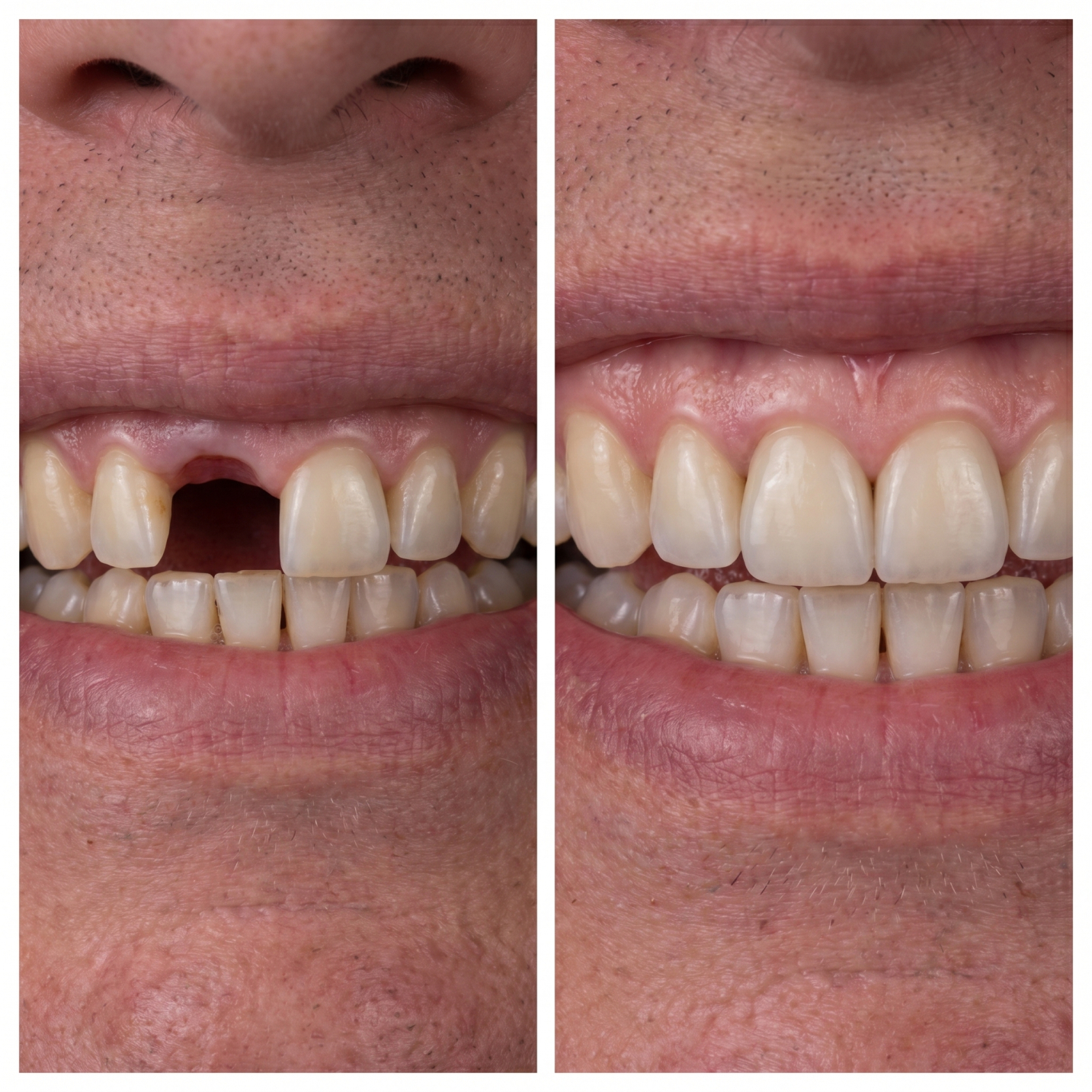 Patient smile transformation 3