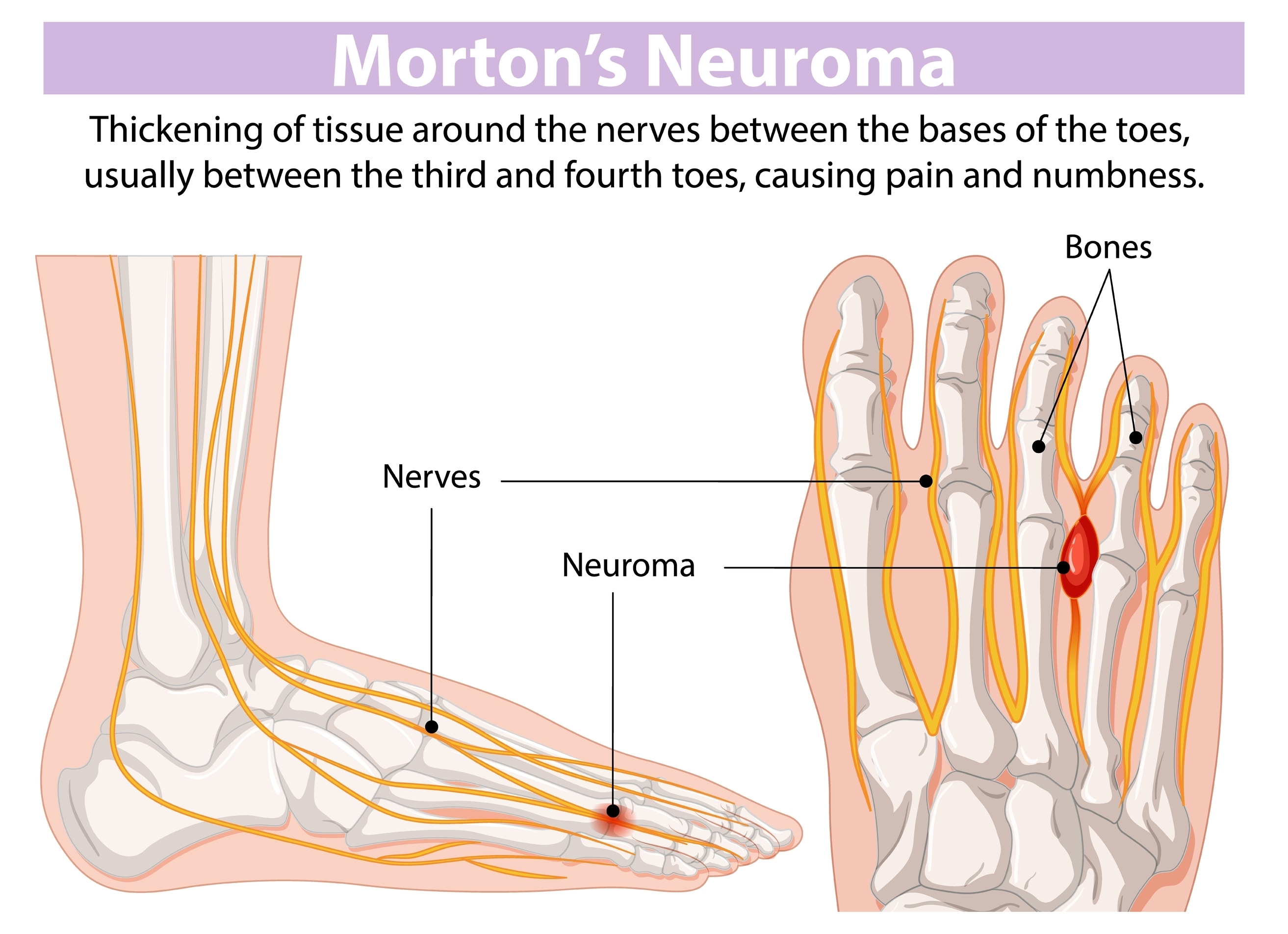 Morton's Neuroma at Meridian Family Acupuncture