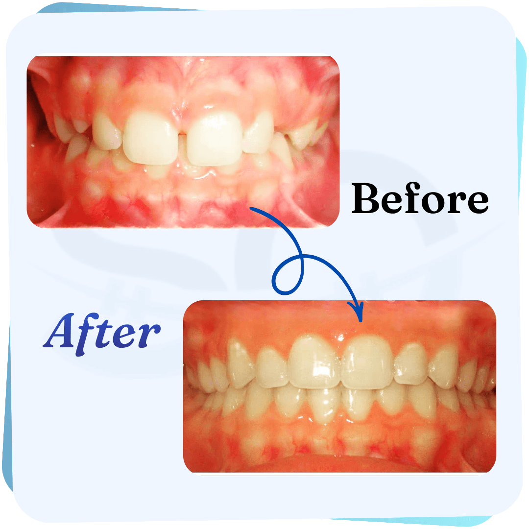 After treatment