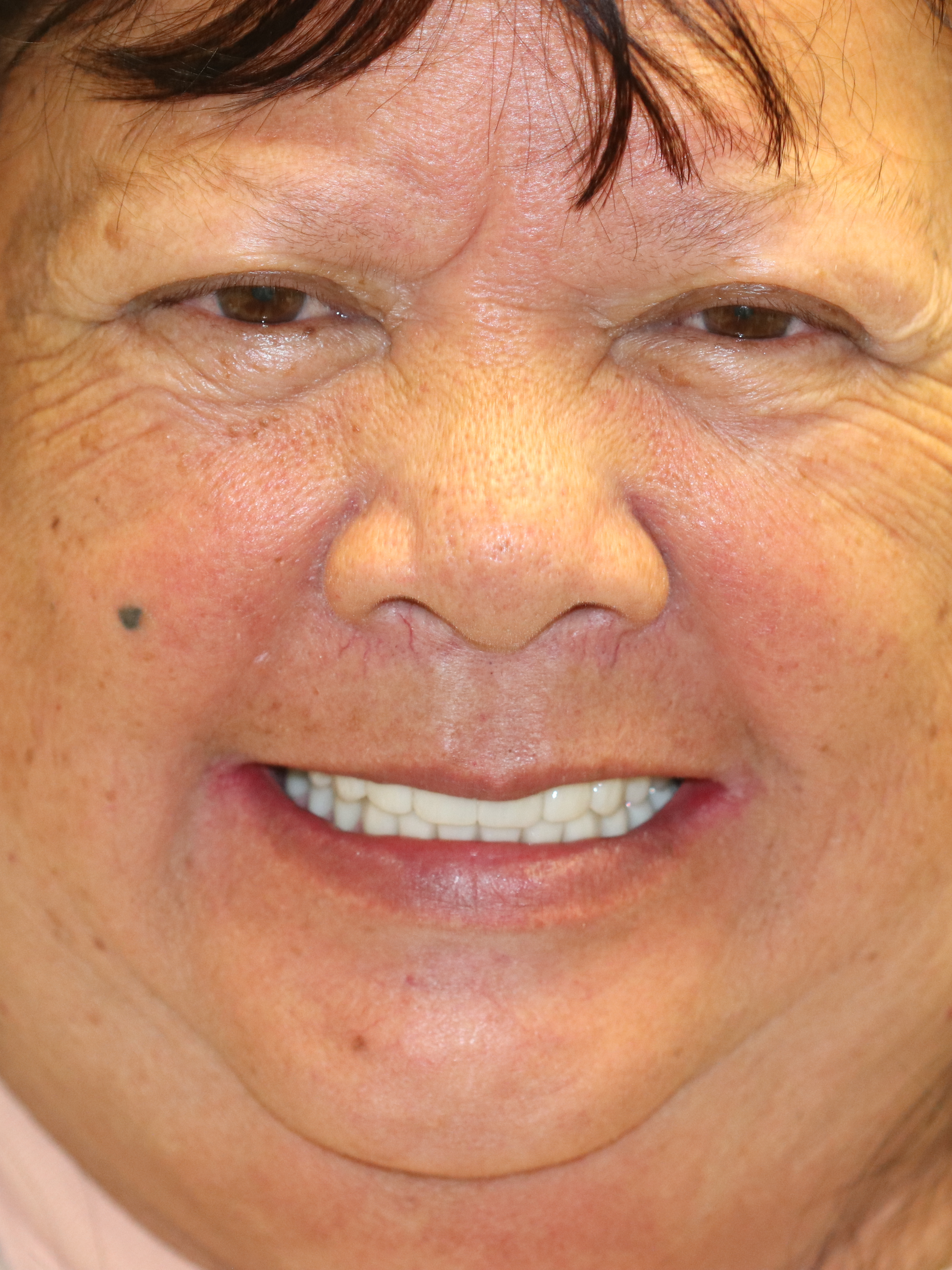 Patient smile after dental implant treatment