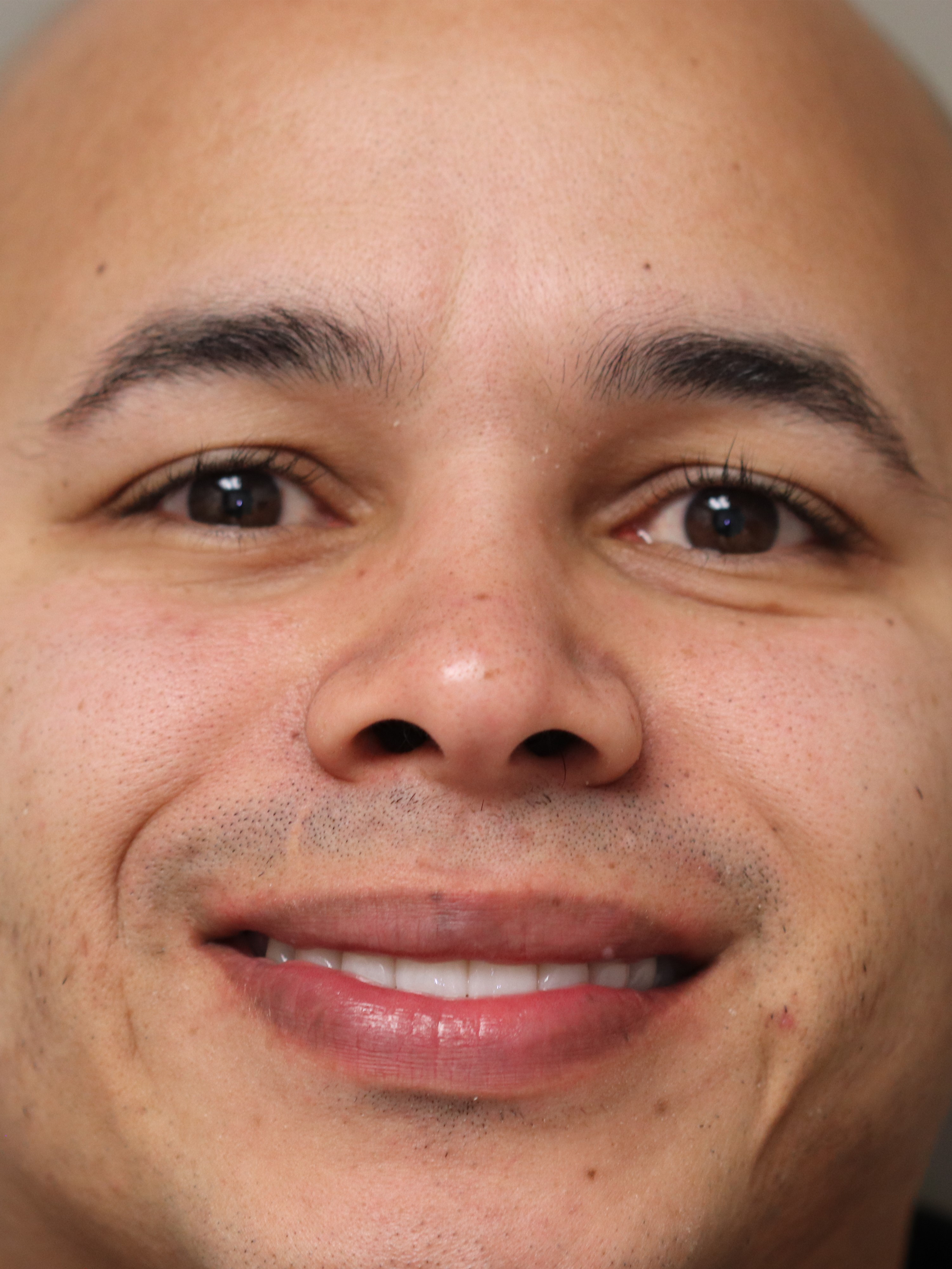 Patient smile after dental implant treatment