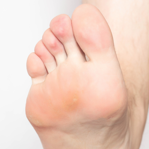 Why do my corns keep coming back?