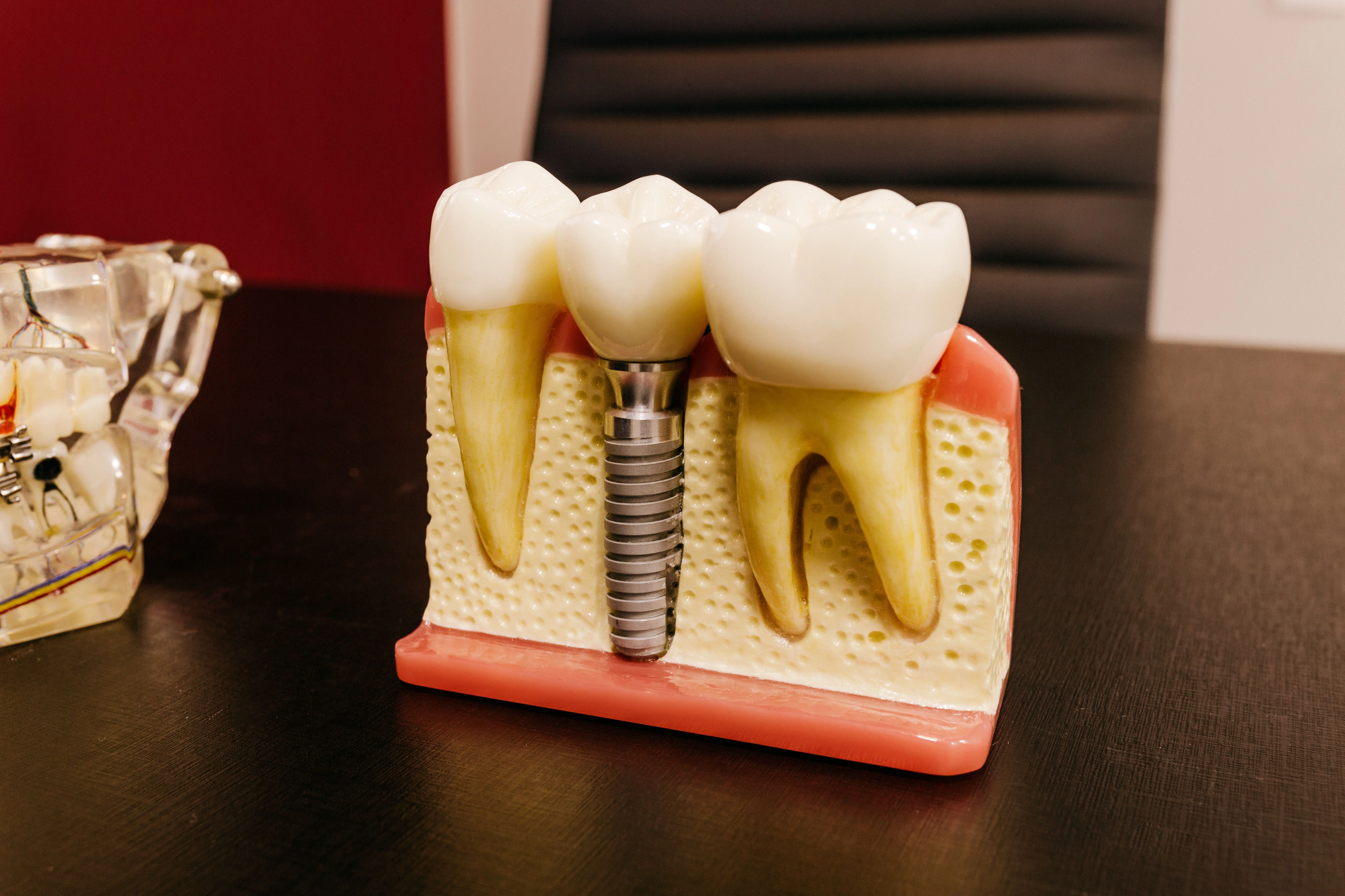 Dental implants for replacing missing teeth and restoring a natural-looking smile