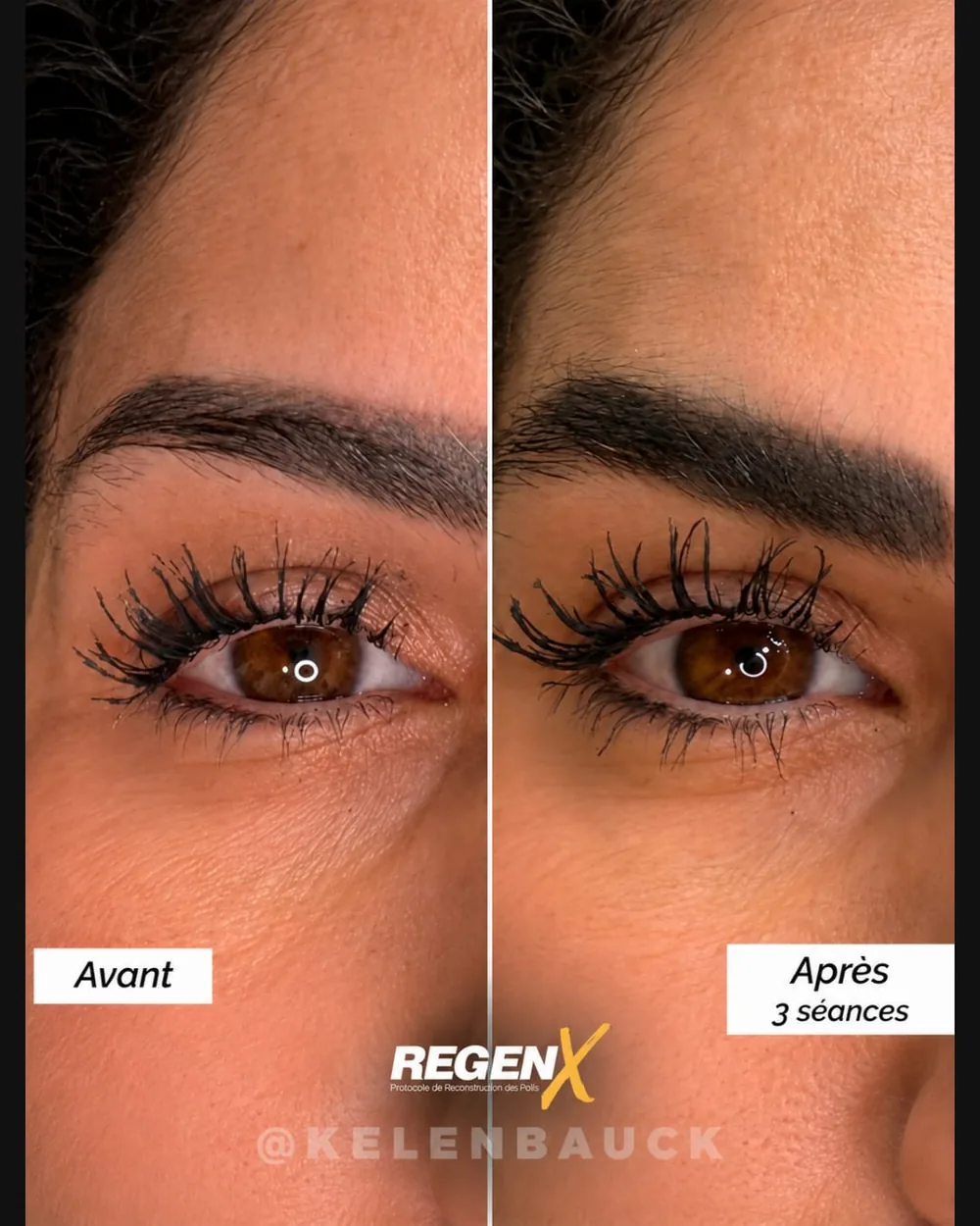 Sourcils avant et après 3 séances RegenX
