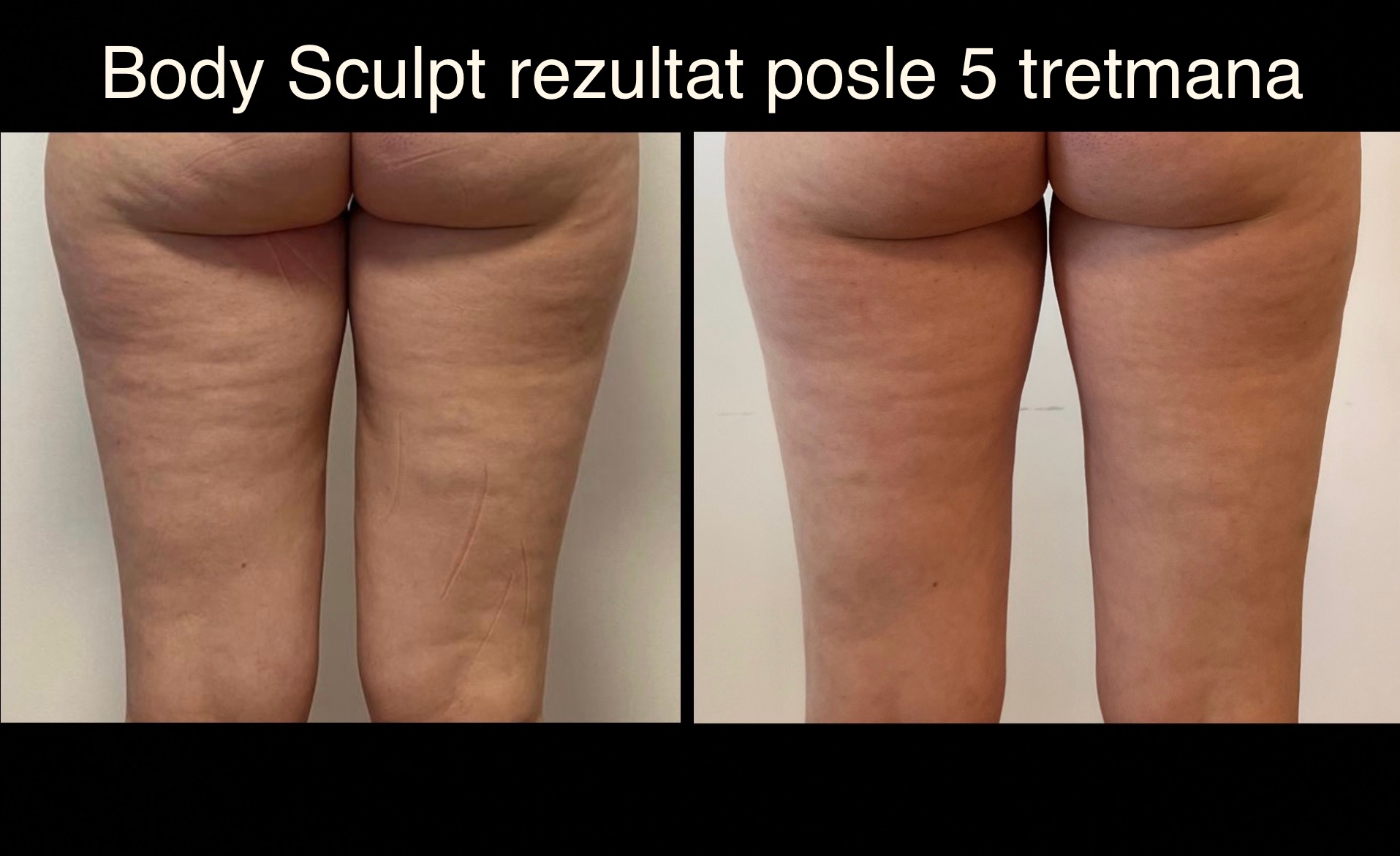 Body Sculpt rezultat posle pet tretmana