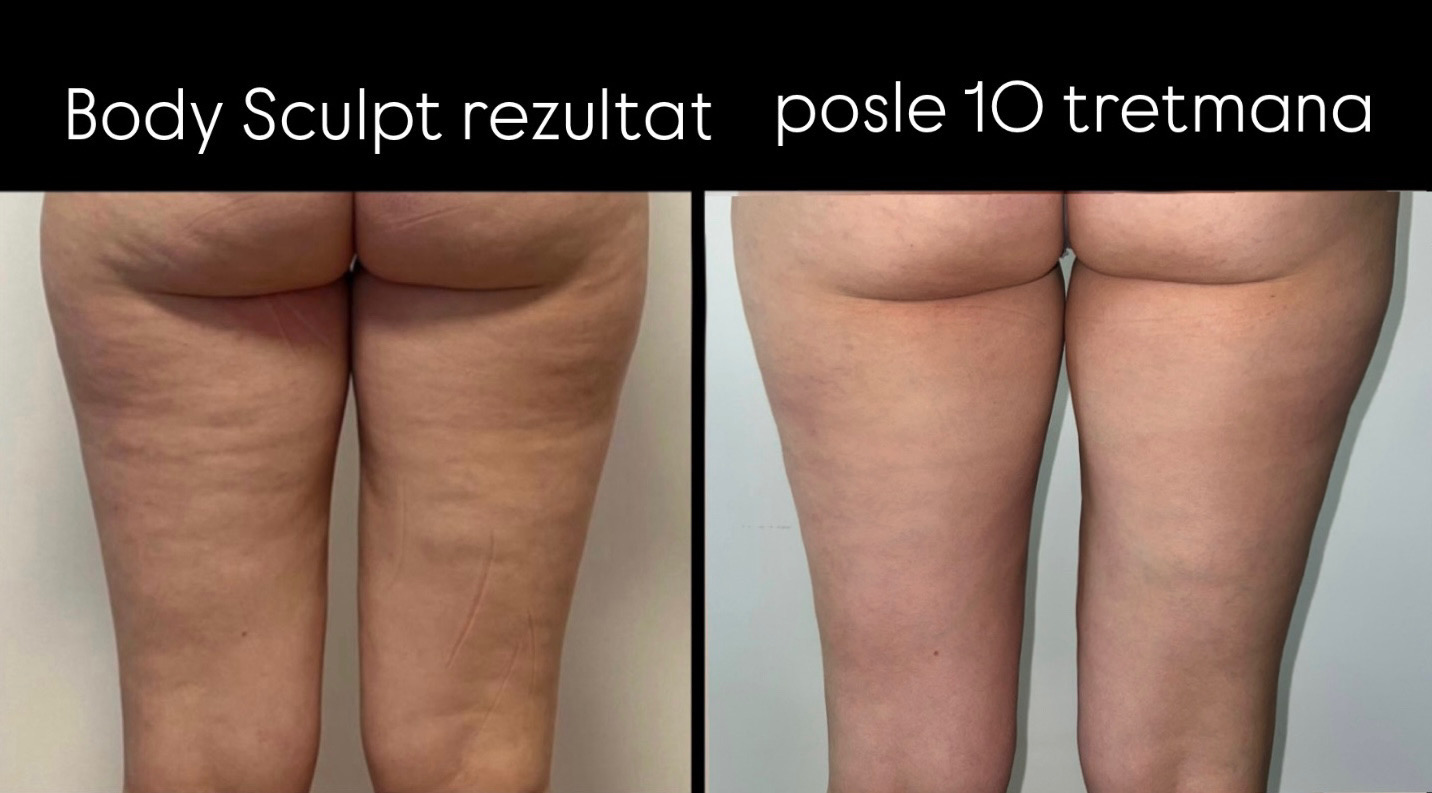 Rezultat pre i posle, zadnja strana butina, posle deset tretmana