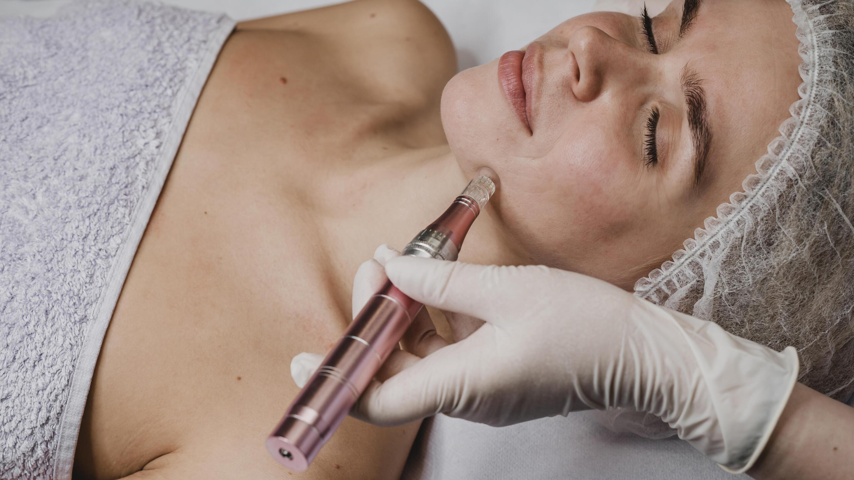 Microneedling