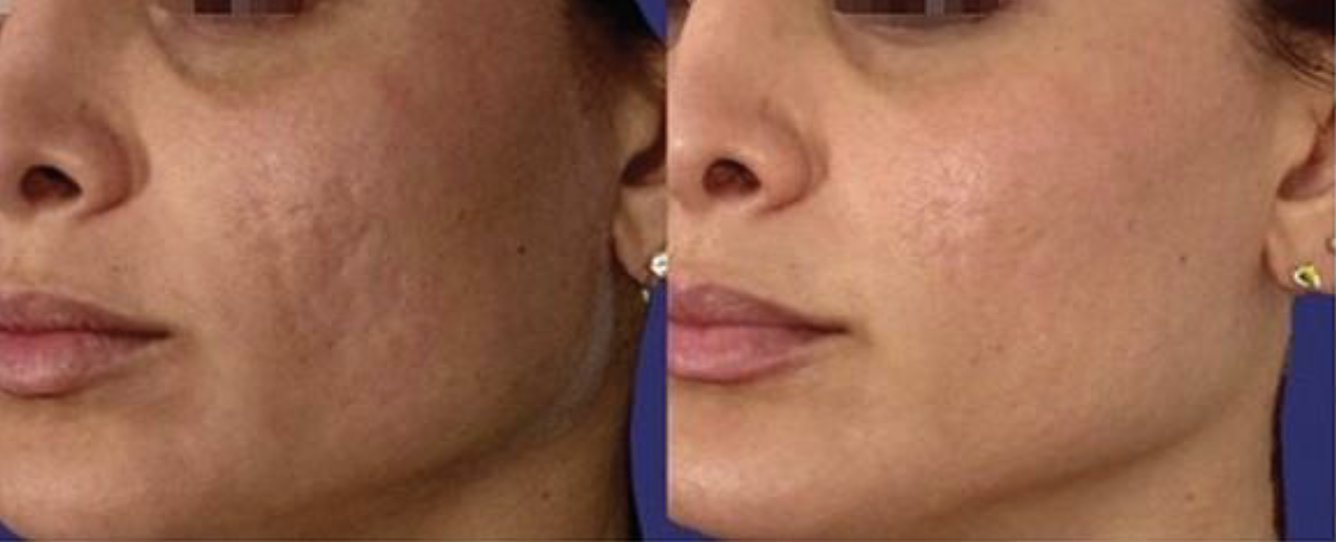 Before and after iPixel resurfacing at Dr Mandi Cosmetic Skin Clinic