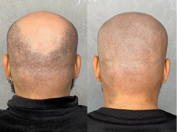Effet crâne rasé