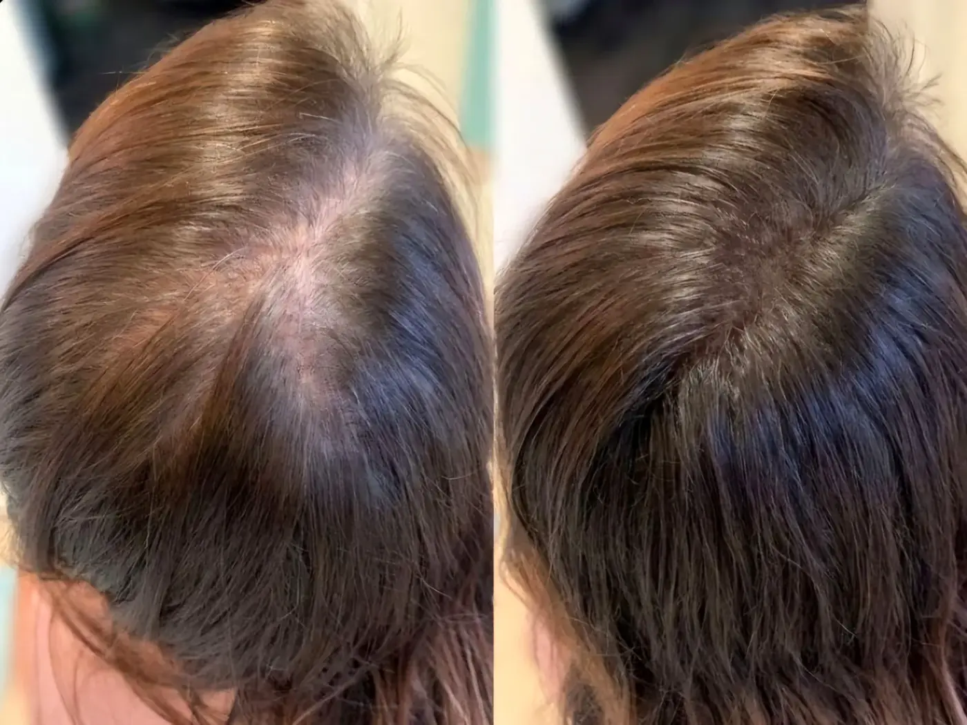 Tricopigmentation densification capillaire – Blush France Bordeaux