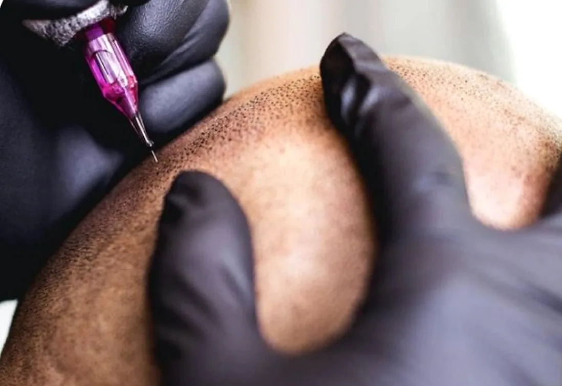 Tricopigmentation en cours à l'institut Blush France, Bordeaux