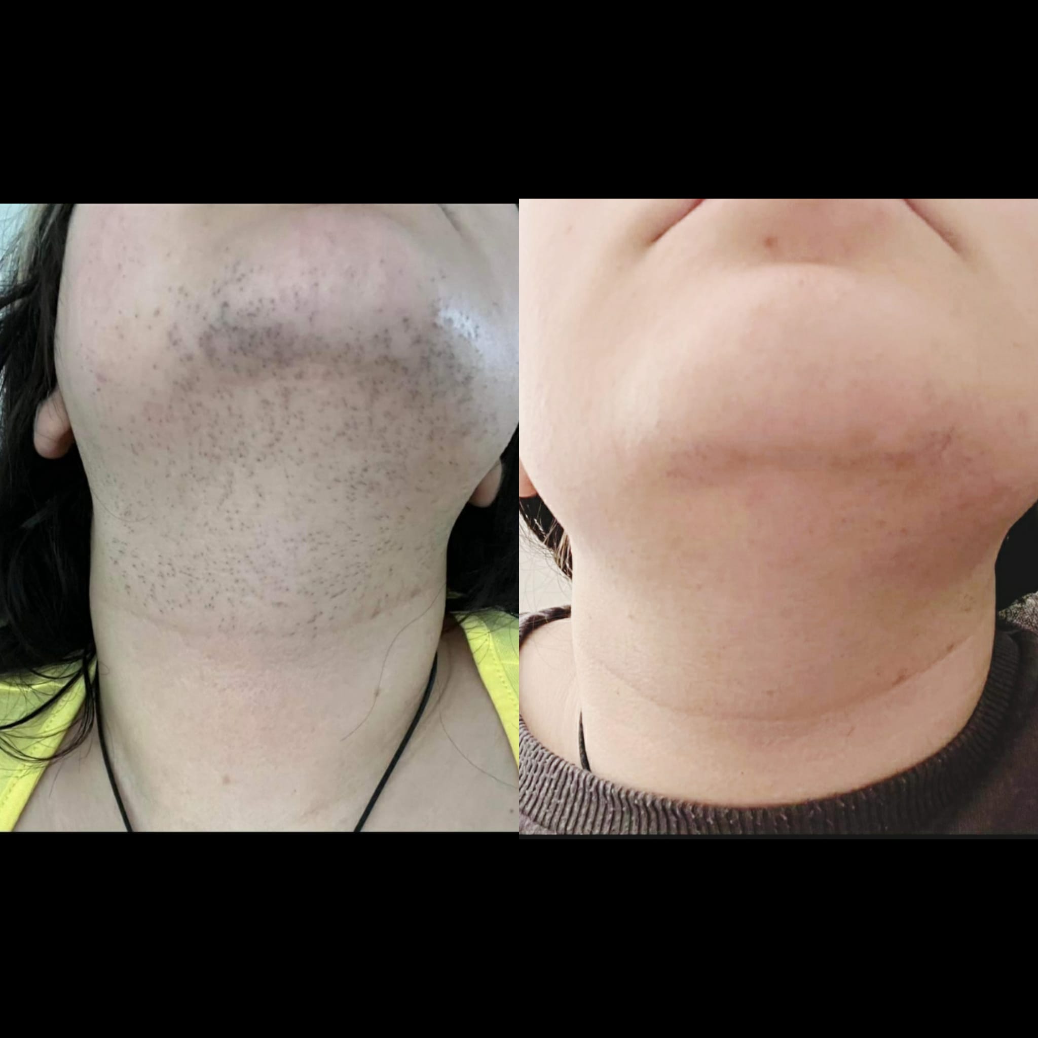 Laser hair removal before and after result
