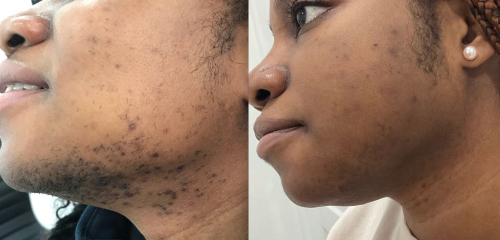 Laser hair removal before and after result