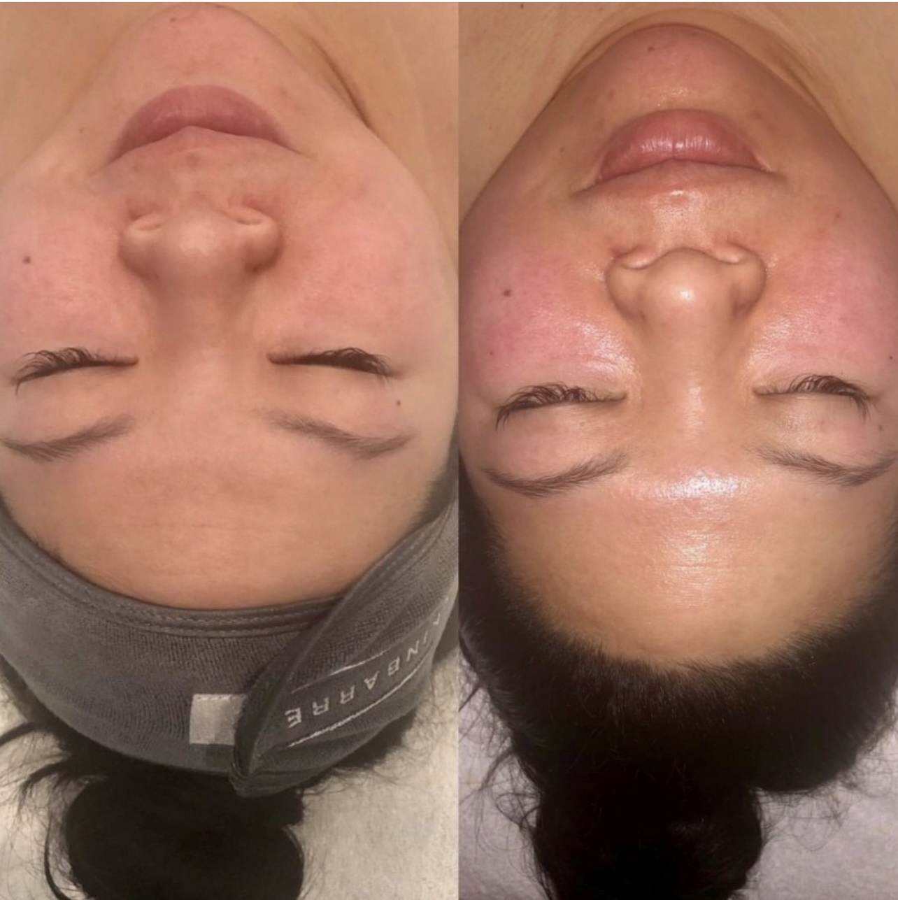 hydrafacial hydrafacial
