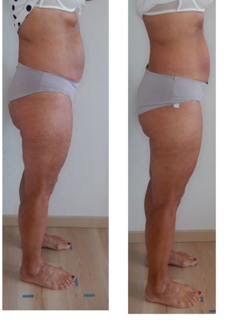 Vorher-Nachher Ergebnis 5