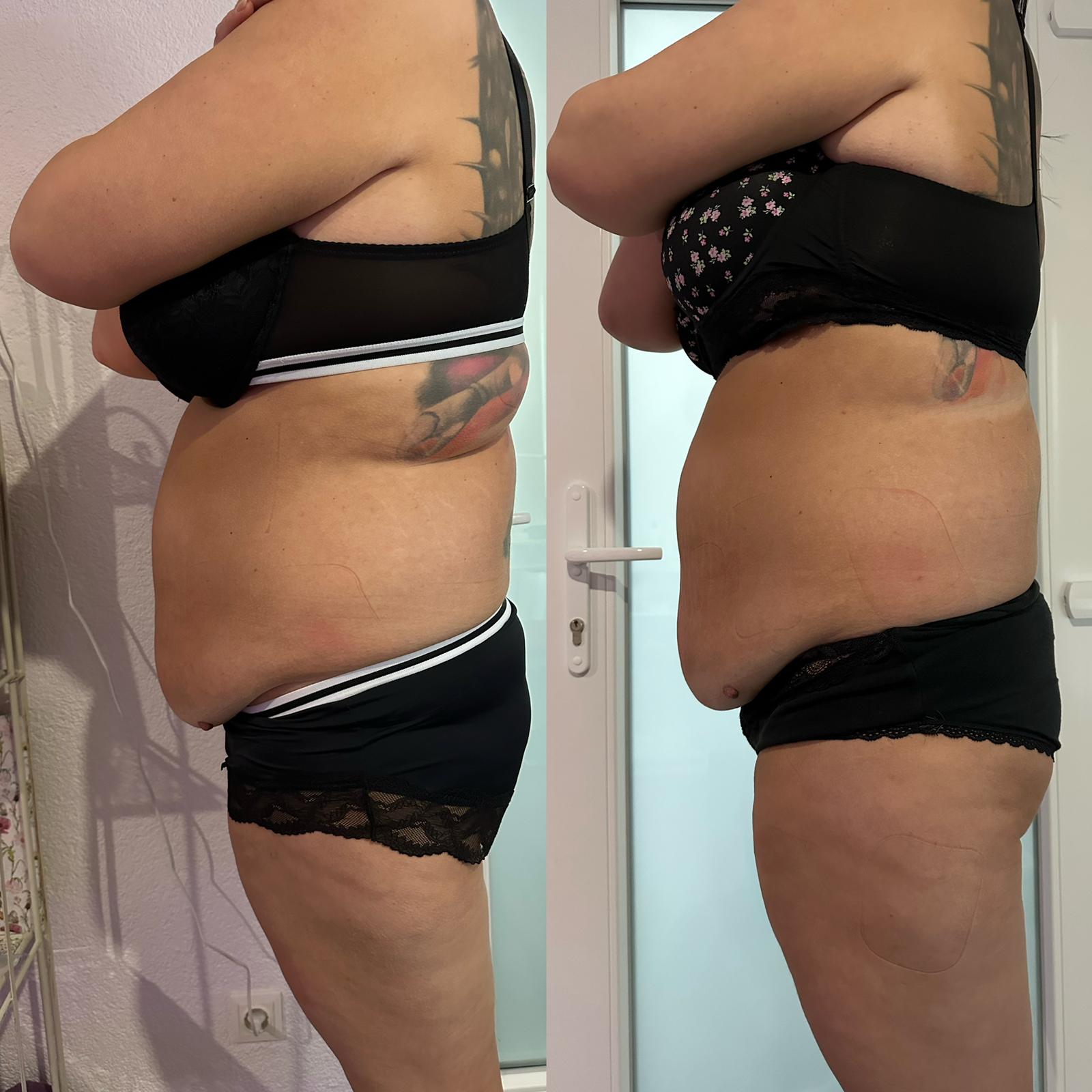 Vorher-Nachher Ergebnis 3