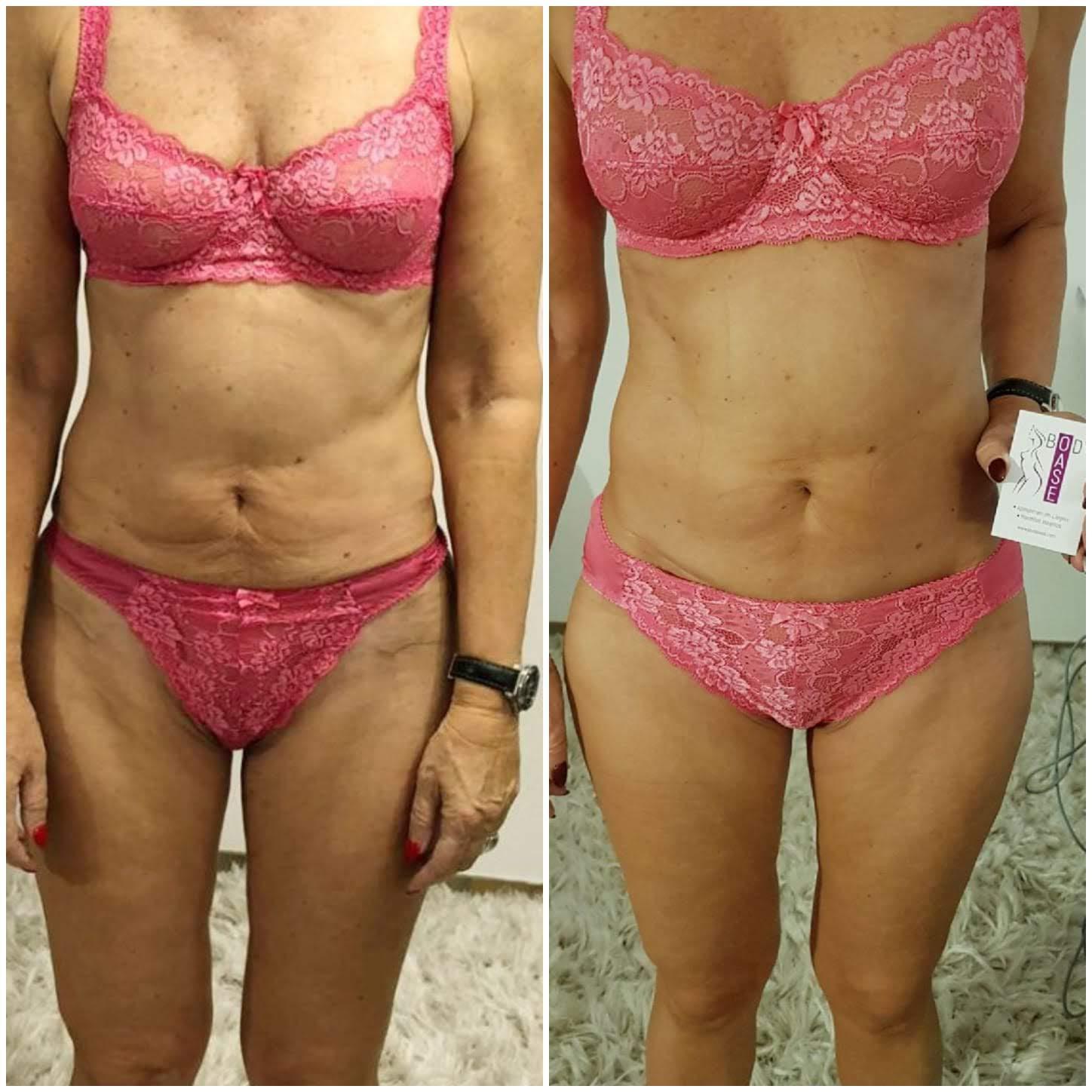 Vorher-Nachher Ergebnis 1