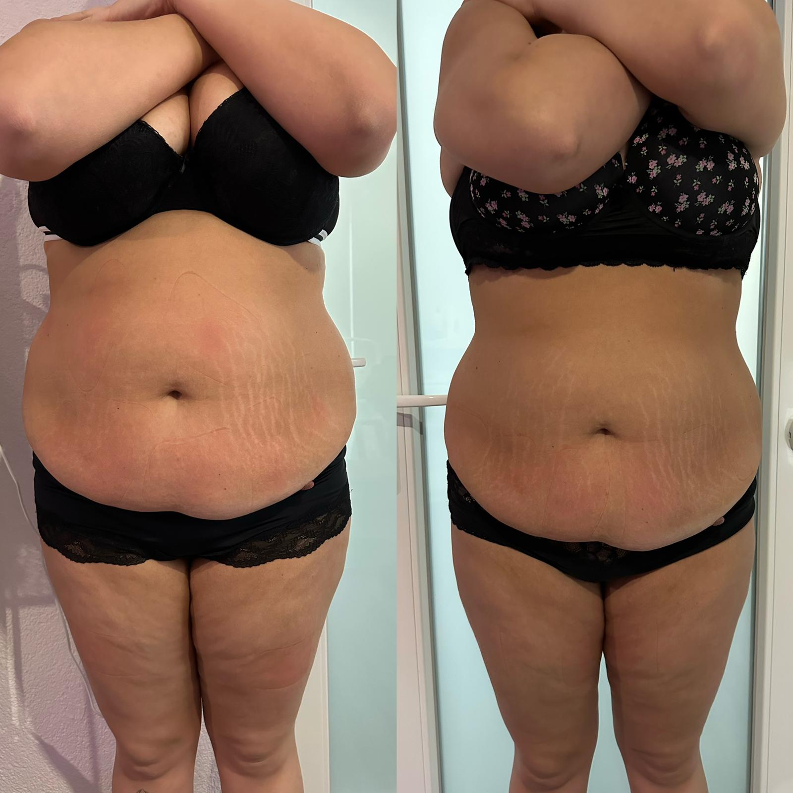 Vorher-Nachher Ergebnis 2