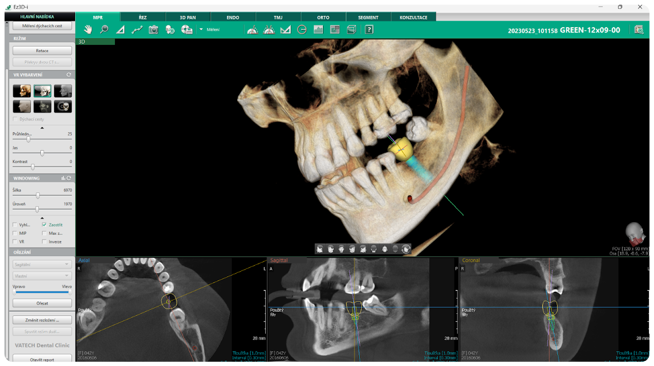 Vatech GreenX12 3D CBCT készülék