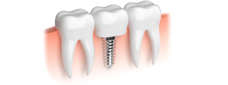 Fogászati implantátum beültetés