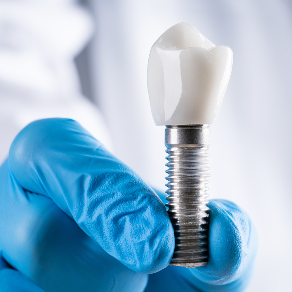 Implantáció fogászati kezelés