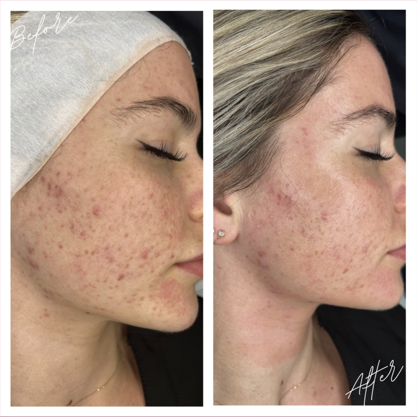 Skin result 2